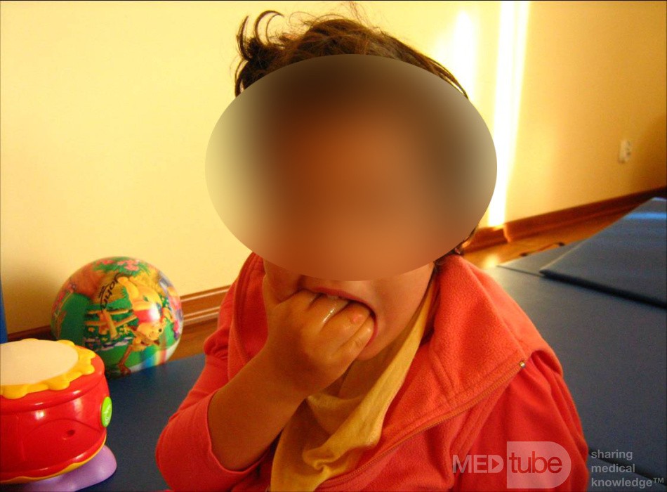 Rett Syndrome
