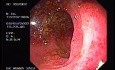 Rectal Bleeding (2 of 2)