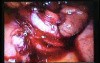Jejunal Gastrointestinal Stromal tumor (GIST) (66 of 86)