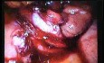 Jejunal Gastrointestinal Stromal tumor (GIST) (66 of 86)