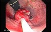 Tubulo - Villous Rectal Adenoma - Endoscopy (19 of 35)