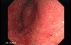 Colitis Ulcerosa - Pseudopolyps (18 of 22)