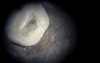 Maxillary Molar Endo Access - Ultrasonic MB2 Troughing Microscope