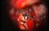 Brain Aneurysm