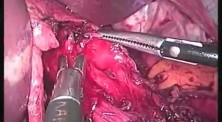 Cardiomyotomy with Anterior Fundoplication - SILS 