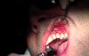Overlying Tissue Suturing - Gingival Grafting #11-12