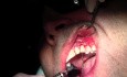 Overlying Tissue Suturing - Gingival Grafting #11-12