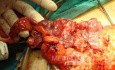 Severe case of Ischemic Colitis (12 of 19)