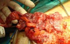 Severe case of Ischemic Colitis (12 of 19)