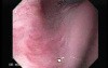 Esophageal Squamous Cell Carcinoma (1 of 3 )