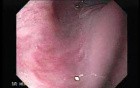 Esophageal Squamous Cell Carcinoma (1 of 3 )