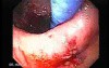Esophagus - Pneumatic Dilation for Achalasia - Dilated Balloon