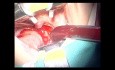 Adenoidectomy