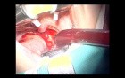 Adenoidectomy
