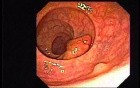Tubulo-Villous Adenoma