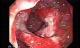 Multiple Adenomatous Polyps Of The Rectum (2 of 37)
