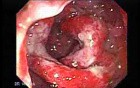 Multiple Adenomatous Polyps Of The Rectum (2 of 37)