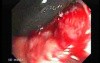 Familial Adenomatous Polyposis (23 of 36)