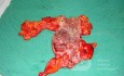Severe case of Ischemic Colitis (15 of 19)
