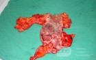 Severe case of Ischemic Colitis (15 of 19)
