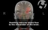 Brain Injury