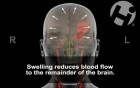 Brain Injury