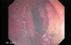 Rectal Stalked Polyp (5 of 7)