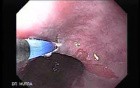 Barrett's Esophagus of long segment (5 of 11)