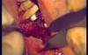 Regeneration Of Multialveolar Process (Right-Side) (2/3)