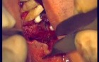 Regeneration Of Multialveolar Process (Right-Side) (2/3)
