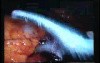 Jejunal Gastrointestinal Stromal tumor (GIST) (62 of 86)