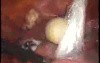 Laparoscopic Management Of Bilateral Dermoide Ovarian Cyst