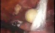 Laparoscopic Management Of Bilateral Dermoide Ovarian Cyst