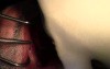Extractions #4-7 With Simple Socket Bone Grafting, Part I