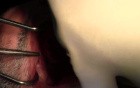 Extractions #4-7 With Simple Socket Bone Grafting, Part I