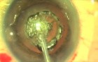 Cataract - New Approach For The Surgery Of Small Eyes