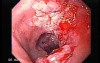 Esophageal Squamous Cell Carcinoma of the the upper third of the Esophagus (2 of 3 )