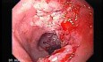 Esophageal Squamous Cell Carcinoma of the the upper third of the Esophagus (2 of 3 )