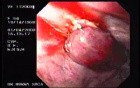 Banding of Esophageal Varices