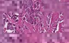 Carcinoid tumor