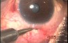 Transconjunctival Transciliary Filtration 