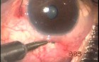 Transconjunctival Transciliary Filtration 