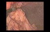 Laparoscopic Repair of Ventral Hernia