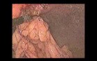 Laparoscopic Repair of Ventral Hernia