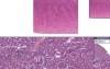 Kidney - Nephrocalcinosis