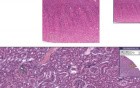Kidney - Nephrocalcinosis
