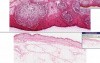 Furuncle (Abscess)