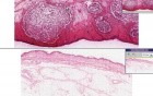 Furuncle (Abscess)
