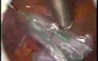 Laparoscopic Ovariectomy On Dermoid Ovarian Cyst