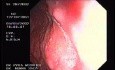 Zollinger- Ellison Syndrome - Gastric Ulcer with Gastrocolic Fistula (14 of 21)